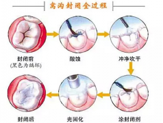 从浅龋到拔牙!牙齿给了我们很多机会!