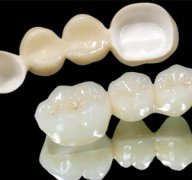 美牙冠使用年限有多长