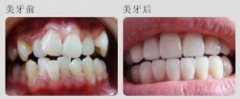 牙齿不整齐怎么办