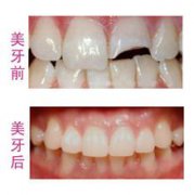 宁波牙齿断了怎么办