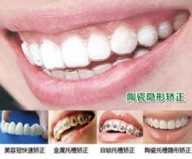 成人正畸牙齿