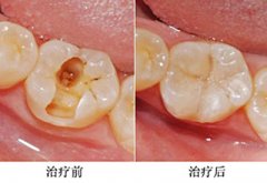 牙齿烂了怎么办